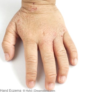 Hand Eczema