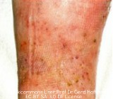 What Is Psoriasis